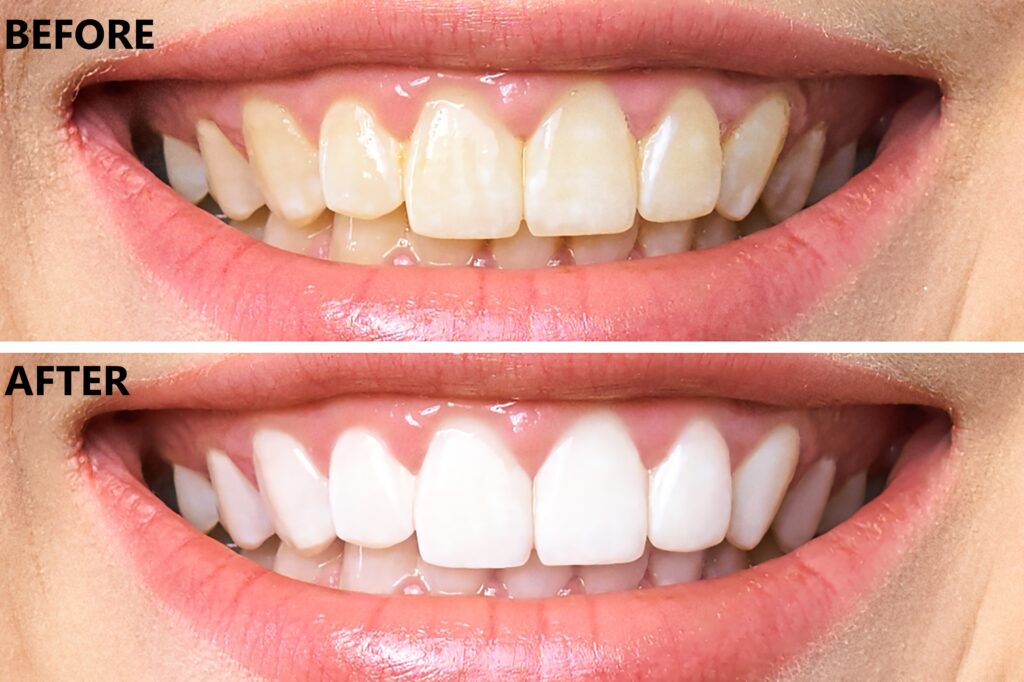 Laser Teeth Whitening Swindon Ambience Dental Practice