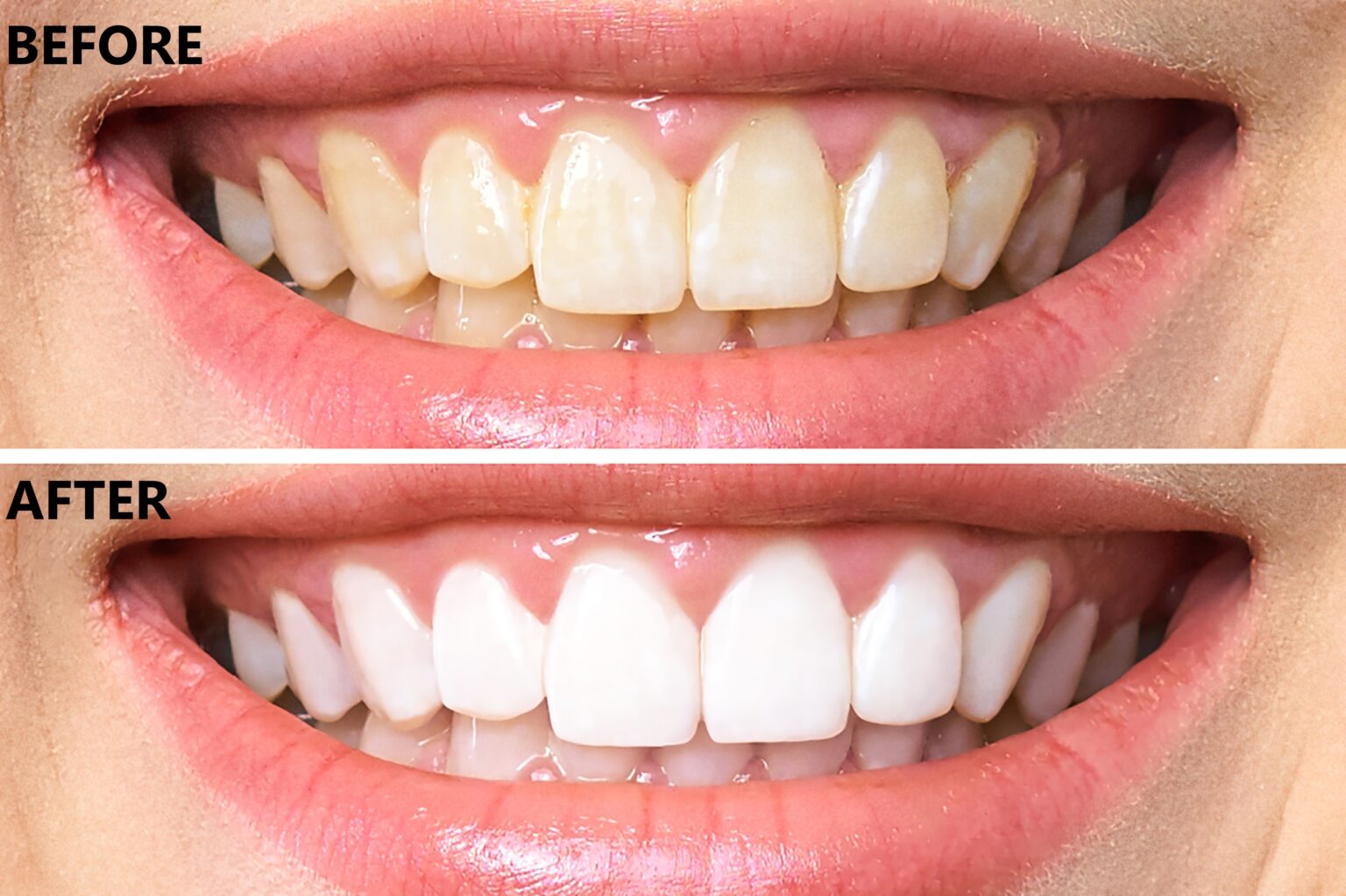 laser-teeth-whitening-swindon-ambience-dental-practice